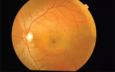 Central Serous Chorioretinopathy