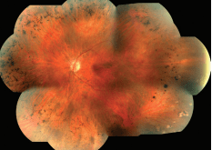 What is Retinitis Pigmentosa?